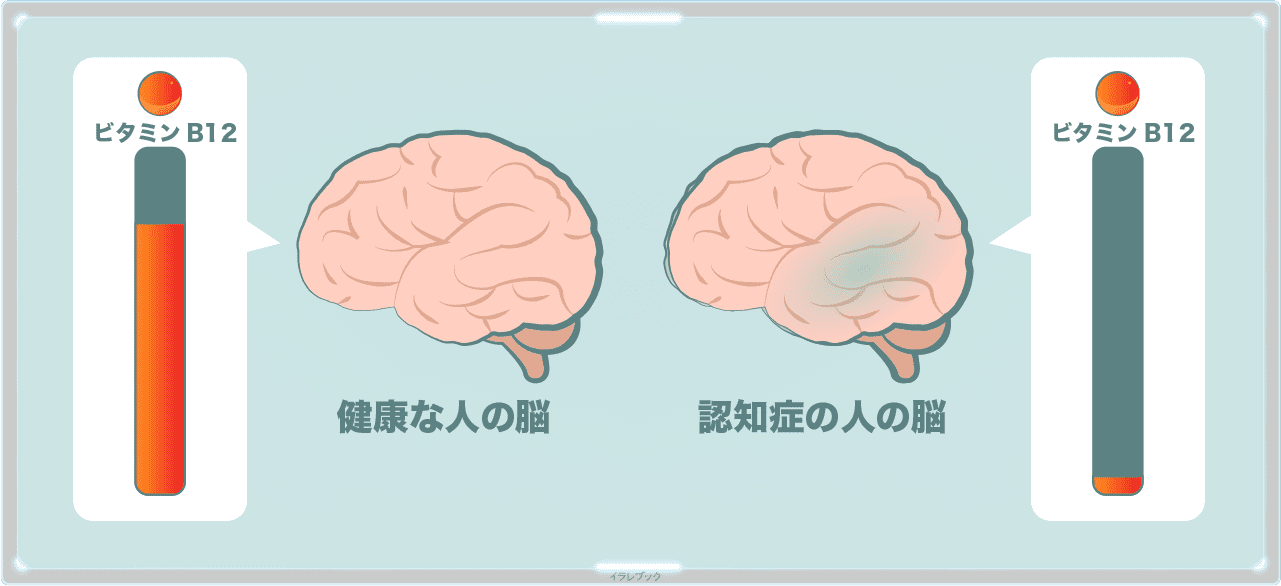 ビタミンB12は健康な脳に多い栄養素で認知症の人の脳内では著しく少ない